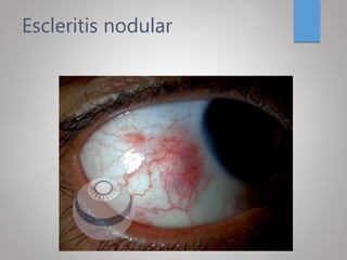 Escleritis nodular
 