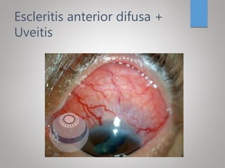 Escleritis anterior difusa +
Uveitis
 