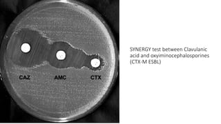 SYNERGY test between Clavulanic
acid and oxyiminocephalosporines
(CTX-M ESBL)
 