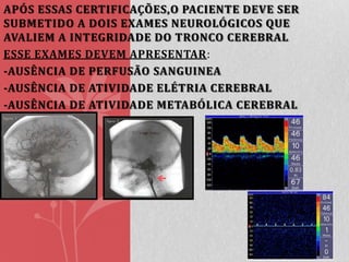 APÓS ESSAS CERTIFICAÇÕES,O PACIENTE DEVE SER
SUBMETIDO A DOIS EXAMES NEUROLÓGICOS QUE
AVALIEM A INTEGRIDADE DO TRONCO CEREBRAL
ESSE EXAMES DEVEM APRESENTAR:
-AUSÊNCIA DE PERFUSÃO SANGUINEA
-AUSÊNCIA DE ATIVIDADE ELÉTRIA CEREBRAL
-AUSÊNCIA DE ATIVIDADE METABÓLICA CEREBRAL

 