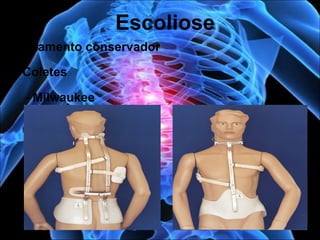 Tratamento conservador
Escoliose
• Coletes
- Milwaukee
 