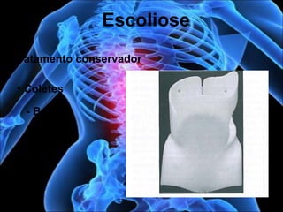Tratamento conservador
Escoliose
• Coletes
- Boston
 