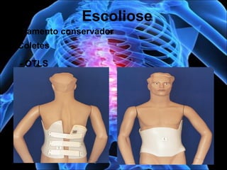 Tratamento conservador
Escoliose
• Coletes
- OTLS
 