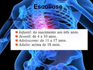 Classificação
Escoliose
 