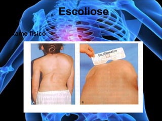 Exame físico
Escoliose
 