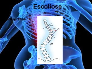 Radiografias
Escoliose
 