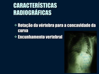 CARACTERÍSTICASCARACTERÍSTICAS
RADIOGRÁFICASRADIOGRÁFICAS
 Rotação da vértebra para a concavidade daRotação da vértebra para a concavidade da
curvacurva
 Encunhamento vertebralEncunhamento vertebral
 