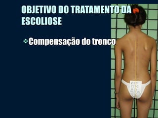 OBJETIVO DO TRATAMENTO DAOBJETIVO DO TRATAMENTO DA
ESCOLIOSEESCOLIOSE
Compensação do troncoCompensação do tronco
 