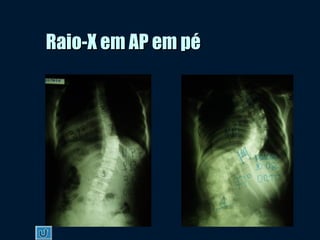 Raio-X em AP em péRaio-X em AP em pé
 