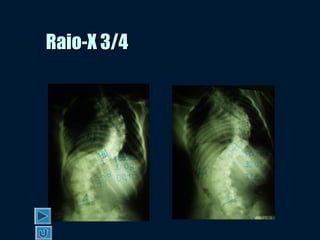 Raio-X 3/4Raio-X 3/4
 