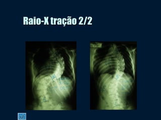 Raio-X tração 2/2Raio-X tração 2/2
 