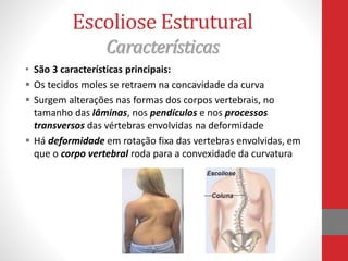 Escoliose Estrutural
Características
• São 3 características principais:
 Os tecidos moles se retraem na concavidade da curva
 Surgem alterações nas formas dos corpos vertebrais, no
tamanho das lâminas, nos pendículos e nos processos
transversos das vértebras envolvidas na deformidade
 Há deformidade em rotação fixa das vertebras envolvidas, em
que o corpo vertebral roda para a convexidade da curvatura
 