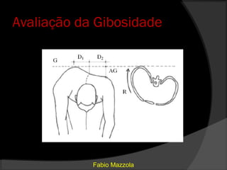 Avaliação da Gibosidade




            Fabio Mazzola
 