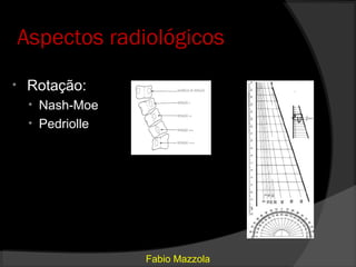 Aspectos radiológicos
•    Rotação:
     • Nash-Moe
     • Pedriolle




                   Fabio Mazzola
 