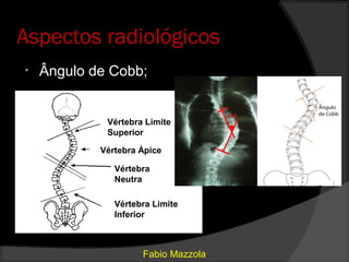 Aspectos radiológicos
•   Ângulo de Cobb;


             Vértebra Limite
             Superior

            Vértebra Ápice

               Vértebra
               Neutra

               Vértebra Limite
               Inferior



                     Fabio Mazzola
 