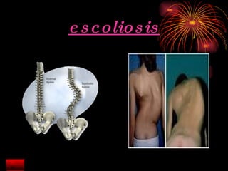 escoliosis 