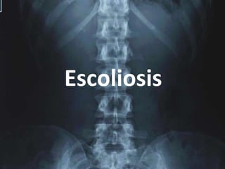 Escoliosis
 