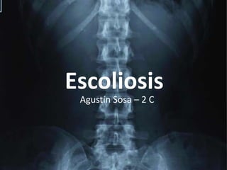 Escoliosis Agustín Sosa – 2 C 