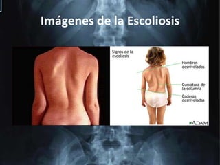 Imágenes de la Escoliosis