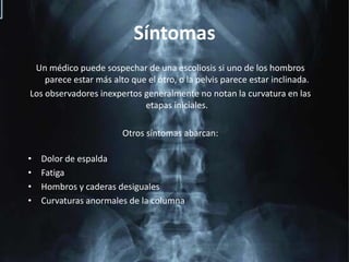 SíntomasUn médico puede sospechar de una escoliosis si uno de los hombros parece estar más alto que el otro, o la pelvis parece estar inclinada. Los observadores inexpertos generalmente no notan la curvatura en las etapas iniciales.Otros síntomas abarcan:Dolor de espaldaFatigaHombros y caderas desigualesCurvaturas anormales de la columna 