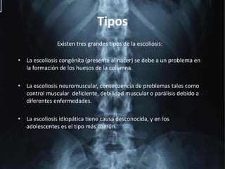 TiposExisten tres grandes tipos de la escoliosis:La escoliosis congénita (presente al nacer) se debe a un problema en la formación de los huesos de la columna.La escoliosis neuromuscular, consecuencia de problemas tales como control muscular  deficiente, debilidad muscular o parálisis debido a diferentes enfermedades.La escoliosis idiopática tiene causa desconocida, y en los adolescentes es el tipo más común.