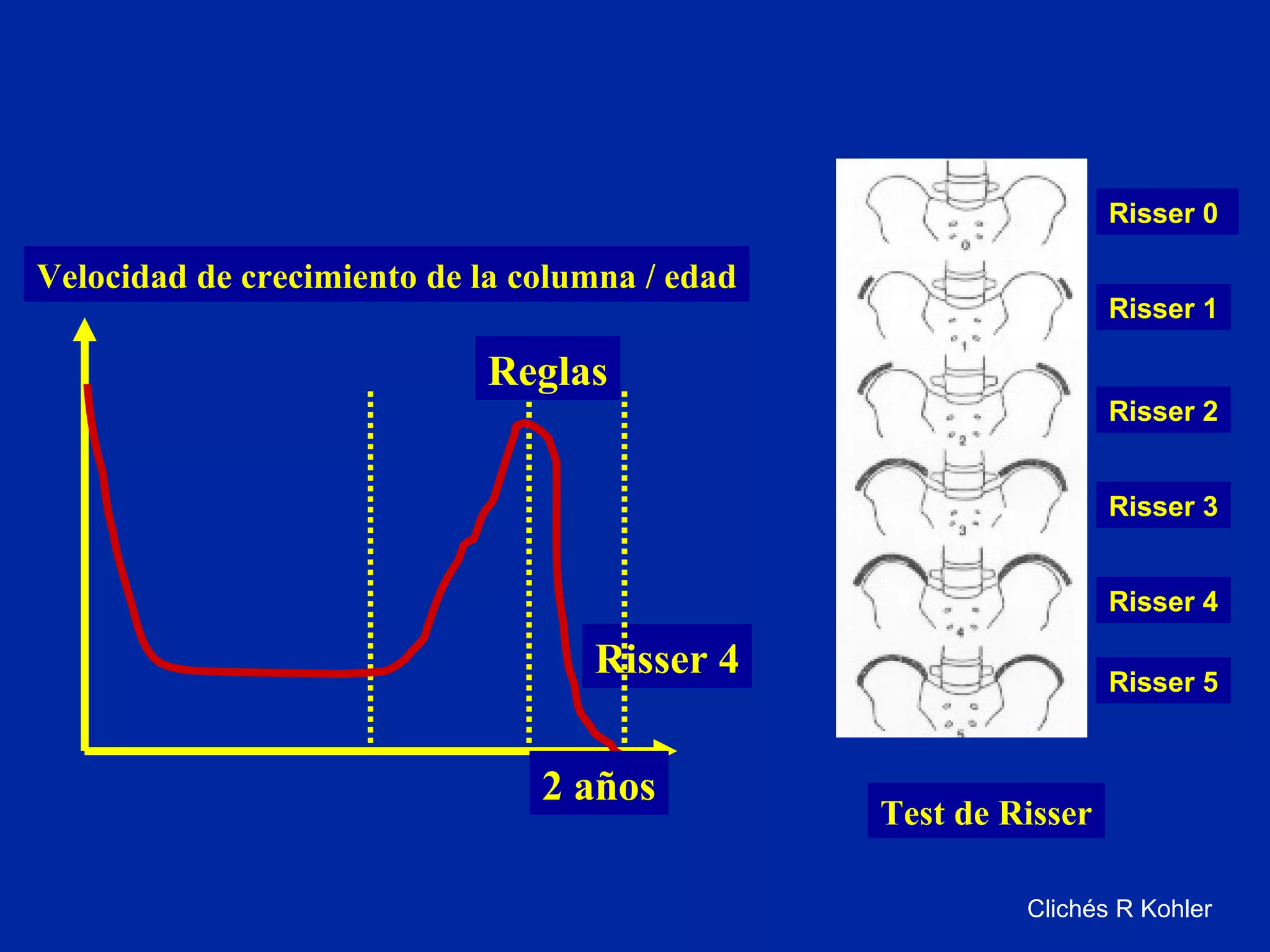 Escoliosis PPT — free download