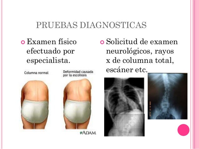 Escoliosis