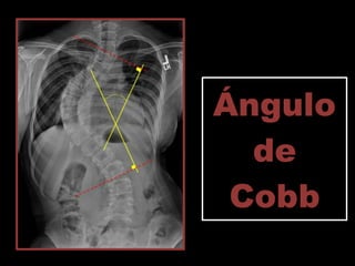 Escoliosis | PDF