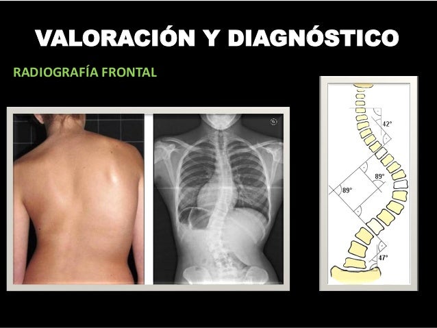 Escoliosis