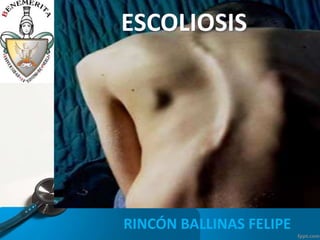 ESCOLIOSIS

RINCÓN BALLINAS FELIPE

 