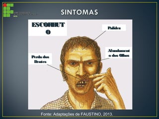 Fonte: Adaptações de FAUSTINO, 2013.
ESCORBUTESCORBUT
OO
Perda dosPerda dos
DentesDentes
PalidezPalidez
AfundamentAfundament
o dos Olhoso dos Olhos
 
