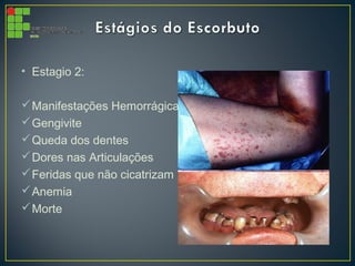 • Estagio 2:
Manifestações Hemorrágicas
Gengivite
Queda dos dentes
Dores nas Articulações
Feridas que não cicatrizam
Anemia
Morte
 