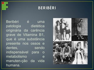 Beribéri é uma
patologia dietética
originária da carência
grave de Vitamina B1,
que é uma substância
presente nos ossos e
dentes, sendo
indispensável para o
metabolismo e
manuten-ção da vida
humana.
 