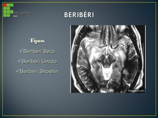 TiposTipos
Beribéri SecoBeribéri Seco
Beribéri ÚmidoBeribéri Úmido
Beribéri ShoshinBeribéri Shoshin
 