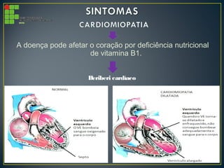 A doença pode afetar o coração por deficiência nutricional
de vitamina B1.
Beriberi cardíaco
 