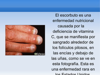 El escorbuto es una
enfermedad nutricional
causada por la
deficiencia de vitamina
C, que se manifiesta por
sangrado alrededor de
los folículos pilosos, en
las encías y debajo de
las uñas, como se ve en
esta fotografía. Esta es
una enfermedad rara en
 