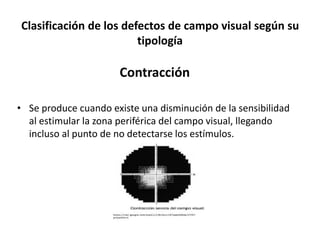 Clasificación de los defectos de campo visual según su
tipología
Contracción
• Se produce cuando existe una disminución de la sensibilidad
al estimular la zona periférica del campo visual, llegando
incluso al punto de no detectarse los estímulos.
 
