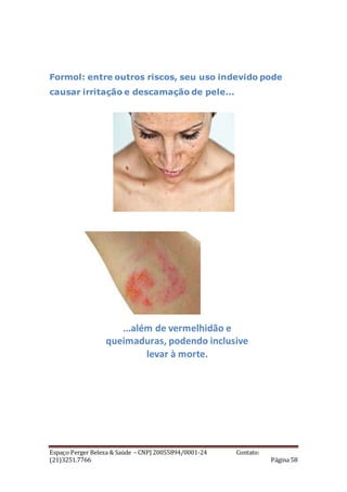 Espaço Perger Beleza & Saúde – CNPJ 20055894/0001-24 Contato:
(21)3251.7766 Página 58
Formol: entre outros riscos, seu uso indevido pode
causar irritação e descamação de pele...
...além de vermelhidão e
queimaduras, podendo inclusive
levar à morte.
 