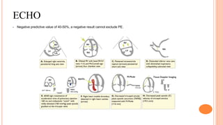 ECHO
• Negative predictive value of 40-50%, a negative result cannot exclude PE.
 