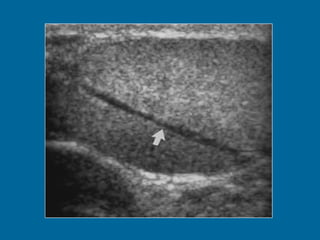 Transverse US scan of the testis shows a normal transmediastinal artery (arrow) as a linear hypoechoic band. Color Doppler flow US (not shown) revealed flow through the vessel. 