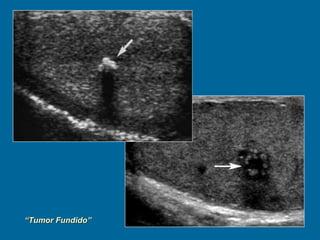 “ Tumor Fundido” fenómeno de "autoquemadura" supone la regresión de un foco de tumor testicular tras la producción de metástasis a distancia, sin conocerse su causa. A pesar de esto, podemos identificar lesiones histológicas características, como son la presencia de una lesión compuesta de tejido colágeno, con células neoplásicas dispersas en su interior. El diagnóstico se realiza mediante el estudio anatomopatológico de la pieza de orquiectomía, debiendo llevarse a cabo ésta en pacientes con tumor germinal extragonadal que presentan alteraciones en la exploración física o en la ecografía. 