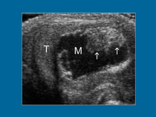 cystic mass  (M) with echogenic borders and peripheral solid components (arrows). A rim of normal testis  (T) is also seen 