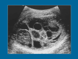 Mature teratoma in a 22-year-old man.  (a) Longitudinal US image of the right testis shows a multilocular cystic mass. The cysts vary in appearance from anechoic to echogenic. 
