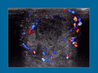 Longitudinal US image of the left testis shows a heterogeneous, predominantly hypoechoic mass, with scattered areas of hypoechogenicity (arrowheads). Normal testicular parenchyma is compressed peripherally by the tumor and contains diffuse microlithiasis (arrow).  (b)  Doppler US image shows normal peripheral vascularity with absence of central flow.  