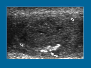 Figure 7. Sertoli cell tumour. Large smooth curvilinear calcification (curved arrow) at the periphery of a heterogeneous mass (open arrows).  