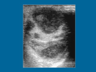 Transverse US image of the left testis shows multiple hypoechoic lesions. 