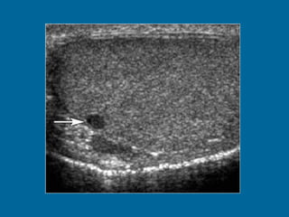 Tunica albuginea cyst in a 36-year-old man.  (a) US image shows a small, peripherally located testicular lesion (arrow) with internal echoes.  (b) On a coronal T2- weighted image, the lesion (arrow) is isointense relative to fluid. The lesion was isointense to fluid with all pulse sequences, a finding that confirmed its cystic nature. The presence of this pathognomonic finding obviated any further intervention. 
