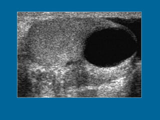 Intratesticular cyst in a 50-year-old man.  (a) US image shows a right-sided 17- mm-diameter intratesticular cyst.  (b) T2-weighted image shows that the lesion (arrow) has the characteristic high signal intensity of fluid. The surrounding thin rim of testicular parenchyma enables diagnosis of an intratesticular cyst. However, note that there is some overlap in imaging appearances of an intratesticular cyst and a tunica albuginea cyst. No further intervention was performed. 