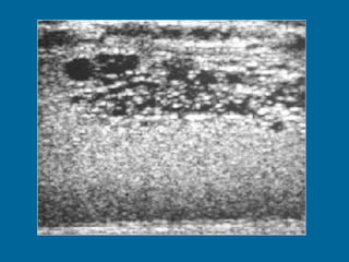 Dilated rete testis in a 44-year-old man.  (a) Sonogram shows multiple small, cystic or tubular, anechoic structures that replace and enlarge the testicular mediastinum. (b) On a T2-weighted image, the lesion has high signal intensity. 