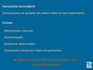 Varicocele secundario Consecuencia de aumento de presión sobre la vena espermática. Causas Hidronefrosis marcada. Hepatomegalia. Neoplasias abdominales. Compresión venosa por masa retroperitoneal. Su aspecto no varia a diferencia del primario, con la posición del paciente 